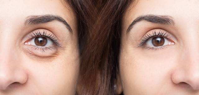 التخلص من انتفاخ تحت العين لا جراحيًا: ما هو علاج الحوض المسيل للدموع؟